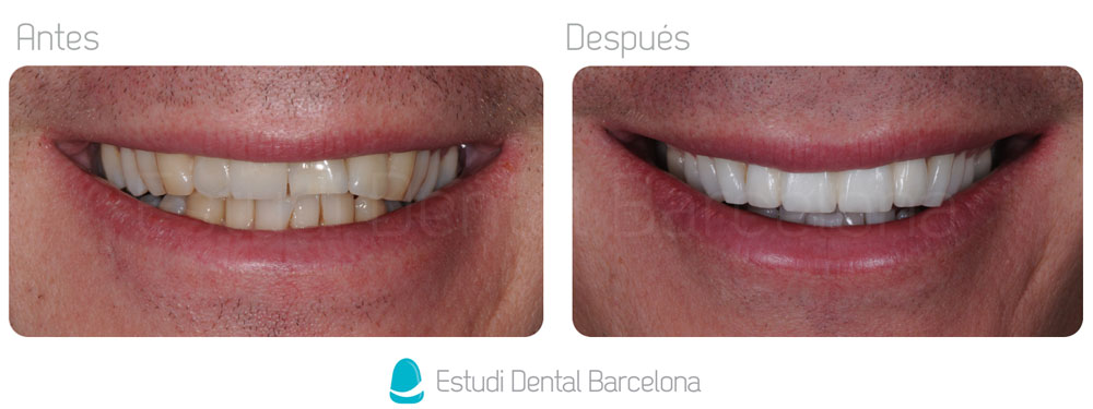 Zirconio o metal en coronas sobre implantes? – Estudi Dental Barcelona