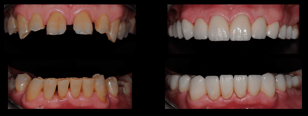 estética dental para desgastes dentales