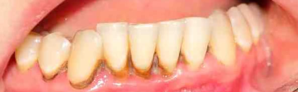 periodoncia barcelona gingivitis