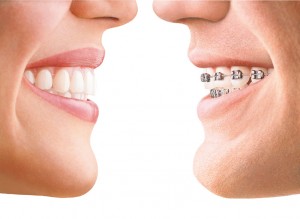 ortodoncia estética invisalign