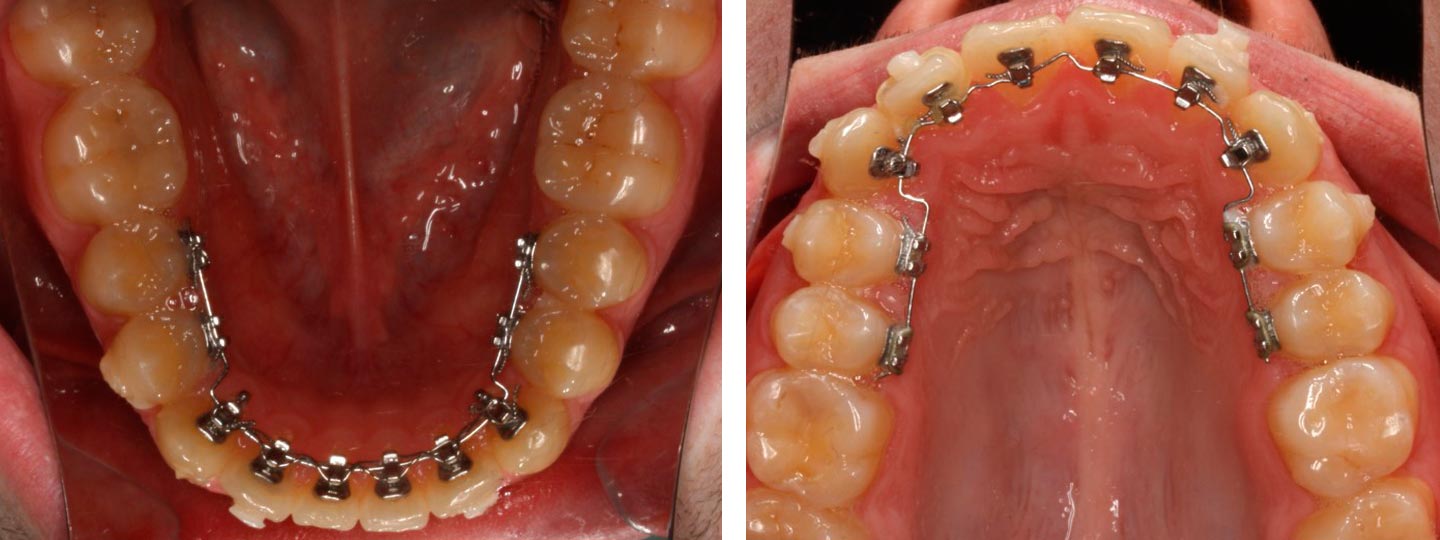 El Bruxismo ¿ Aprietas los dientes por la noche ? - Institut Ortodoncia  Barcelona