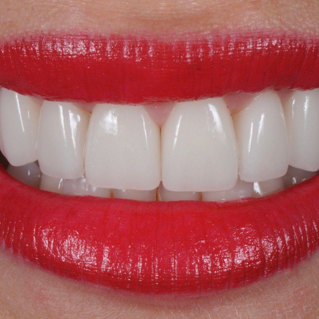 Estética Dental Barcelona